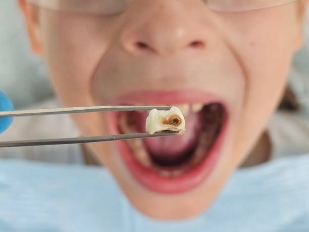 Best Emergency Treatment for Oral Infections in Syracuse, NY